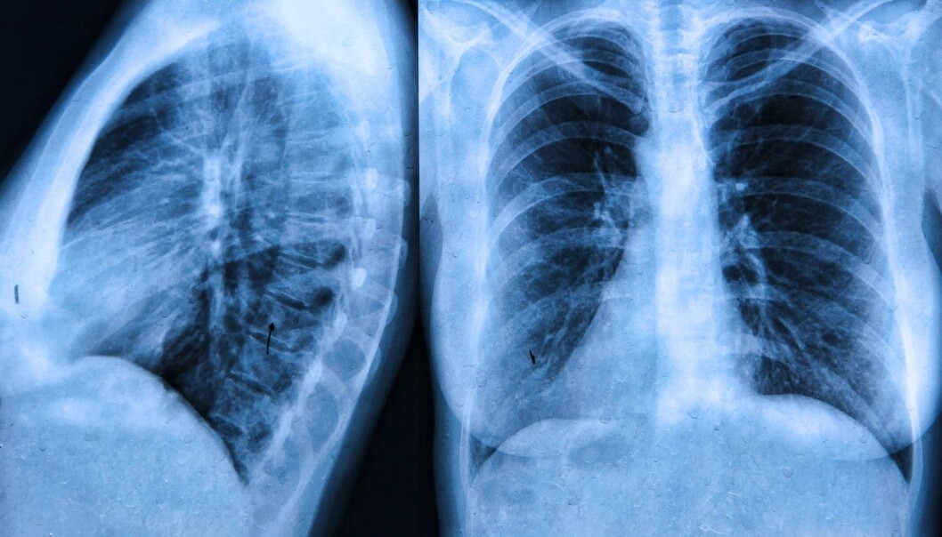 Cystisk fibrose er en sjelden sykdom som kan gjøre at de som sliter med lidelsen får slim i lungene. (Illustrasjonsfoto: Colourbox) Cystisk fibrose er en sjelden sykdom som kan gjøre at de som sliter med lidelsen får slim i lungene. (Illustrasjonsfoto: Colourbox)