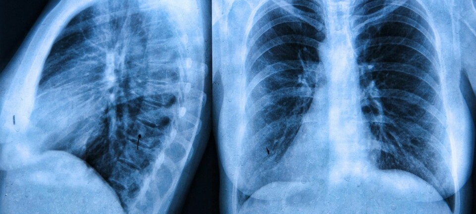 Cystisk fibrose er en sjelden sykdom som kan gjøre at de som sliter med lidelsen får slim i lungene. (Illustrasjonsfoto: Colourbox)