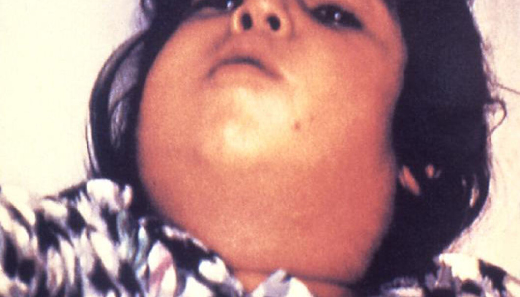 Difteri er en alvorlig sykdom, særlig for barn. Halsen kan hovne så mye opp at det blir vanskelig å puste. (Foto: Public Health Image Library, Centers for Disease Control and Prevention) Difteri er en alvorlig sykdom, særlig for barn. Halsen kan hovne så mye opp at det blir vanskelig å puste. (Foto: Public Health Image Library, Centers for Disease Control and Prevention)