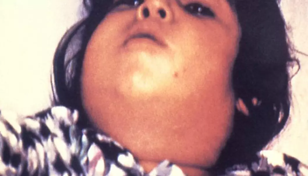 Difteri er en alvorlig sykdom, særlig for barn. Halsen kan hovne så mye opp at det blir vanskelig å puste. (Foto: Public Health Image Library, Centers for Disease Control and Prevention)