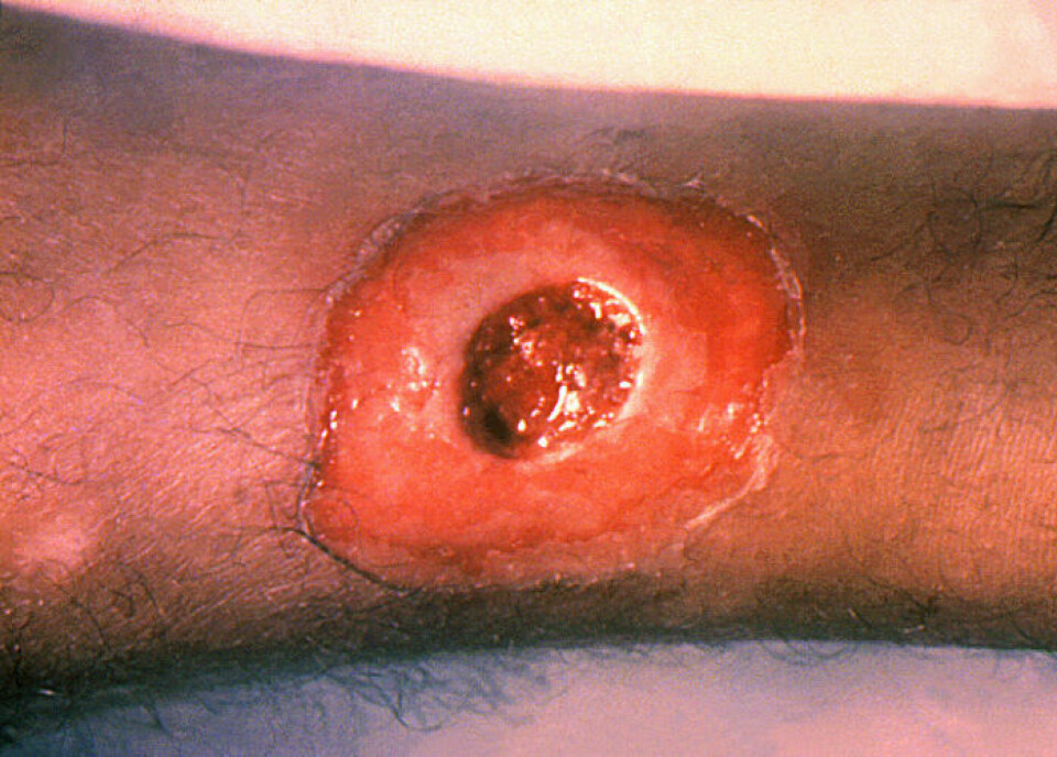 Difteri kan også sette seg som en infeksjon i sår. Da kan det bli et kronisk, åpent sår som ikke gror. (Foto: Public Health Image Library, Centers for Disease Control and Prevention)