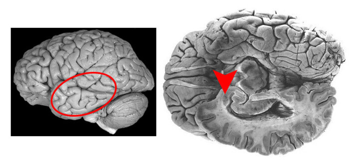 Disse to bildene viser menneskehjernen. Området som kalles amygdala er markert med sirkel og pil. Data fra amygdala ligner på data som NTNU-forskerne har funnet i nattsvermerens laterale horn. (Foto: (Illustrasjon: NTNU)) Disse to bildene viser menneskehjernen. Området som kalles amygdala er markert med sirkel og pil. Data fra amygdala ligner på data som NTNU-forskerne har funnet i nattsvermerens laterale horn. (Foto: (Illustrasjon: NTNU))