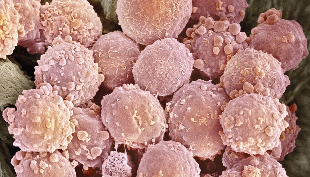 Forskerne ved Radiumhospitalet har utviklet en behandlingsvaksine mot lymfekreft som gjør at kreftcellene blir synlige for immunforsvaret, og dermed elimineres. Bildet viser lymfekreftceller. (Foto: Scanpix, Science Photo Library) Forskerne ved Radiumhospitalet har utviklet en behandlingsvaksine mot lymfekreft som gjør at kreftcellene blir synlige for immunforsvaret, og dermed elimineres. Bildet viser lymfekreftceller. (Foto: Scanpix, Science Photo Library)