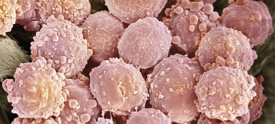 Forskerne ved Radiumhospitalet har utviklet en behandlingsvaksine mot lymfekreft som gjør at kreftcellene blir synlige for immunforsvaret, og dermed elimineres. Bildet viser lymfekreftceller.  (Foto: Scanpix, Science Photo Library)