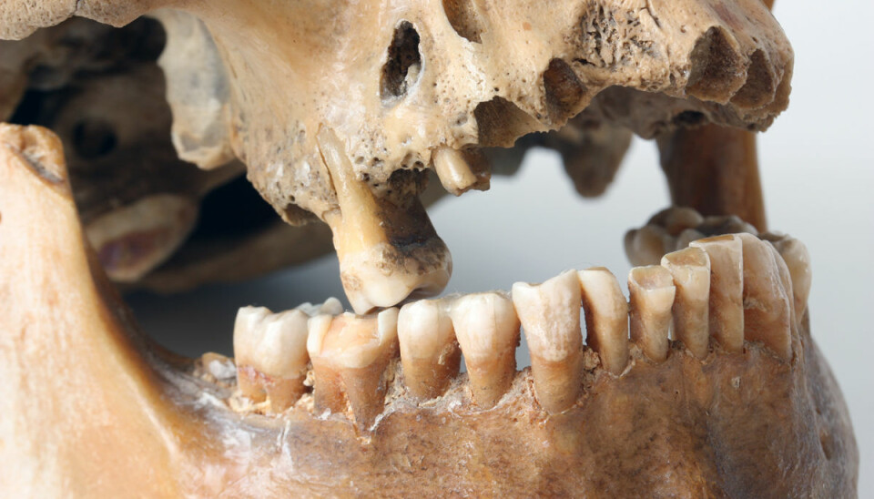 Dårlig tannpuss og tannlegeskrekk? Nifse sykdommer truer i munnhulen. (Illustrasjonsfoto: Colourbox)