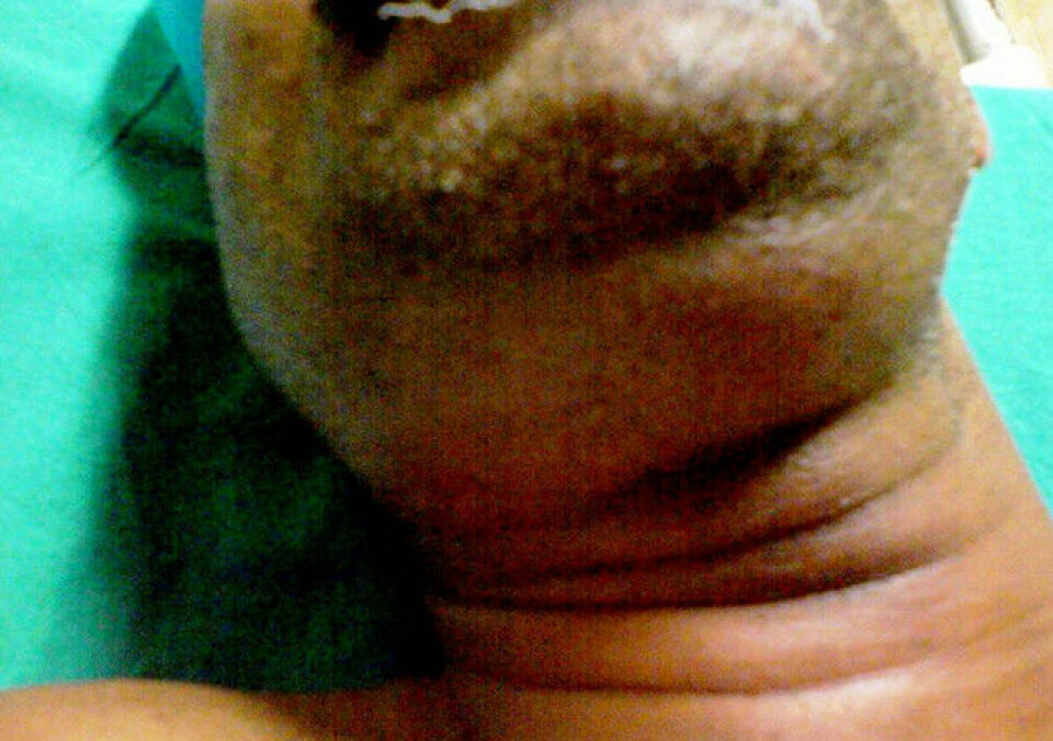 Pasient med hoven underdel av ansiktet på grunn av Ludwigs angina. (Foto: Anand H Kulkarni, Swarupa D Pai, Basant Bhattarai, Sumesh T Rao og M Ambareesha, Creative Commons Attribution 2.0 Generic license.)