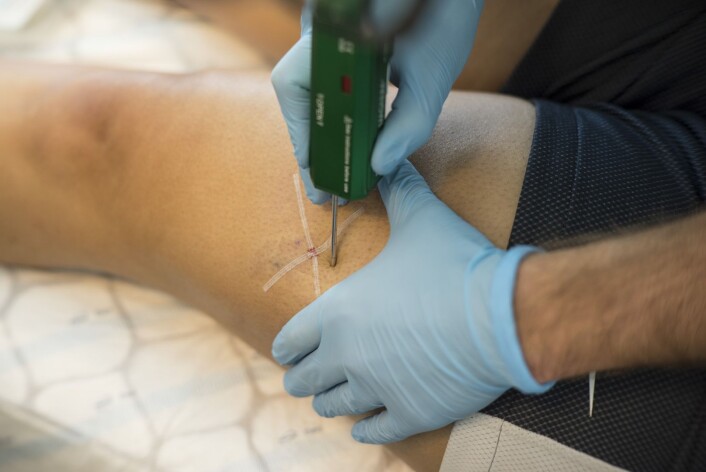 Denne tjukke nåla stikkes 2 centimeter inn i låret, og henter ut muskelceller som skal brukes i forskningsprosjektet. Vondt, men fort gjort. (Foto: Lars Teppan Johansen) Denne tjukke nåla stikkes 2 centimeter inn i låret, og henter ut muskelceller som skal brukes i forskningsprosjektet. Vondt, men fort gjort. (Foto: Lars Teppan Johansen)