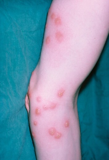 En ny studie amerikanske forskere har foretatt på mus i laboratorium, viser at veggedyr kan overføre den fryktede parasitten Trypanosoma cruzi. Den forårsaker Chagas sykdom. (Foto: Science Photo Library/Scanpix) En ny studie amerikanske forskere har foretatt på mus i laboratorium, viser at veggedyr kan overføre den fryktede parasitten Trypanosoma cruzi. Den forårsaker Chagas sykdom. (Foto: Science Photo Library/Scanpix)