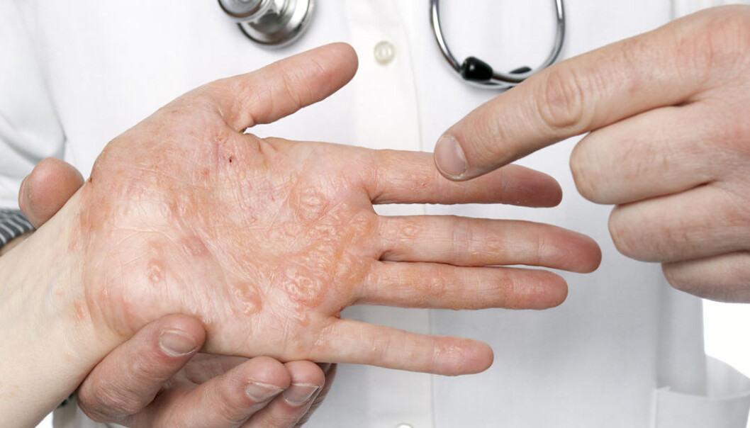 Mange plages av eksem og andre hudsykdommer. Likevel står det dårlig til med hudforskningen i Norge. (Foto: Microstock) Mange plages av eksem og andre hudsykdommer. Likevel står det dårlig til med hudforskningen i Norge. (Foto: Microstock)