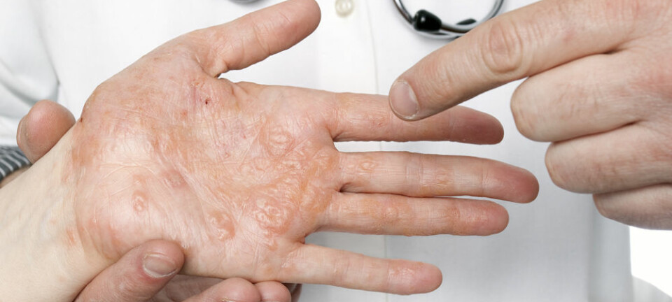 Mange plages av eksem og andre hudsykdommer. Likevel står det dårlig til med hudforskningen i Norge.  (Foto: Microstock)