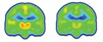 Forskningen viser at smertepasientene hadde vesentlig høyere nivåer av proteinet TSPO i deler av hjernen som har å gjøre med nettopp smerte. Figuren viser et gjennomsnitt av nivåene av proteinet (orange) i hjernene til smertepasienter (til venstre) og friske. (Foto: Colourbox)