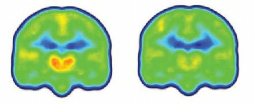 Forskningen viser at smertepasientene hadde vesentlig høyere nivåer av proteinet TSPO i deler av hjernen som har å gjøre med nettopp smerte. Figuren viser et gjennomsnitt av nivåene av proteinet (orange) i hjernene til smertepasienter (til venstre) og friske. (Foto: Colourbox)