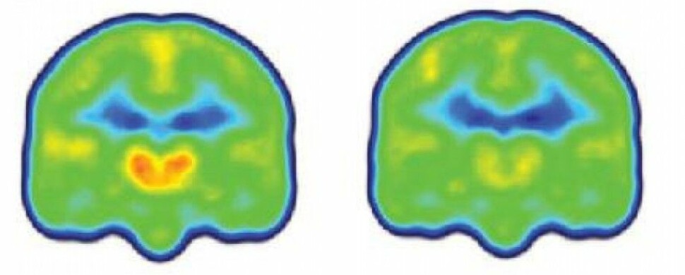 Forskningen viser at smertepasientene hadde vesentlig høyere nivåer av proteinet TSPO i deler av hjernen som har å gjøre med nettopp smerte. Figuren viser et gjennomsnitt av nivåene av proteinet (orange) i hjernene til smertepasienter (til venstre) og friske.