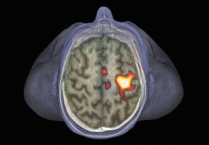 Hjerneskanning av 35 år gammel mann, med fMRI-metoden. Denne metoden måler blodgjennomstrømning i forskjellige områder av hjernen. Områder med høyere blodgjennomstrømning har mer nerveaktivitet, og lyser opp i bildet. Her lyser deler av den motoriske hjernebarken opp, fordi forsøkspersonene rører på venstre hånd. (Foto: Science Photo Library) Hjerneskanning av 35 år gammel mann, med fMRI-metoden. Denne metoden måler blodgjennomstrømning i forskjellige områder av hjernen. Områder med høyere blodgjennomstrømning har mer nerveaktivitet, og lyser opp i bildet. Her lyser deler av den motoriske hjernebarken opp, fordi forsøkspersonene rører på venstre hånd. (Foto: Science Photo Library)