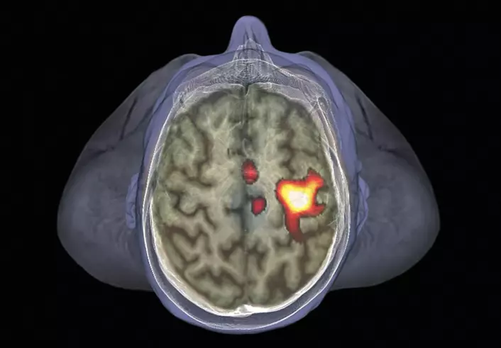Hjerneskanning av 35 år gammel mann, med fMRI-metoden. Denne metoden måler blodgjennomstrømning i forskjellige områder av hjernen. Områder med høyere blodgjennomstrømning har mer nerveaktivitet, og lyser opp i bildet. Her lyser deler av den motoriske hjernebarken opp, fordi forsøkspersonene rører på venstre hånd. (Foto: Science Photo Library)