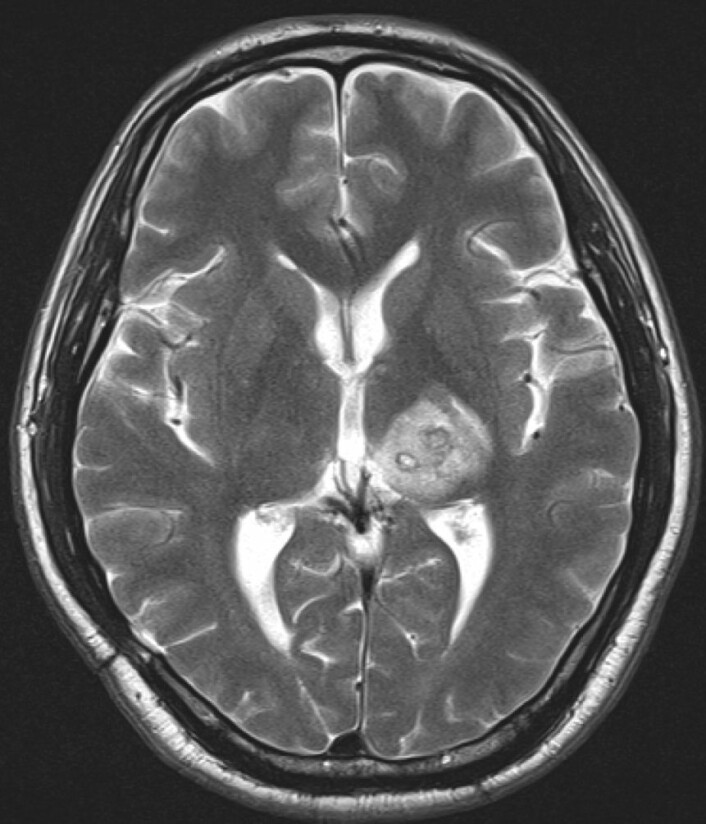 MRI-skann som viser betennelsen i høyre hjernehalvdel fra parasitten i pasientens hjerne. (Foto: Nagui Antoun)