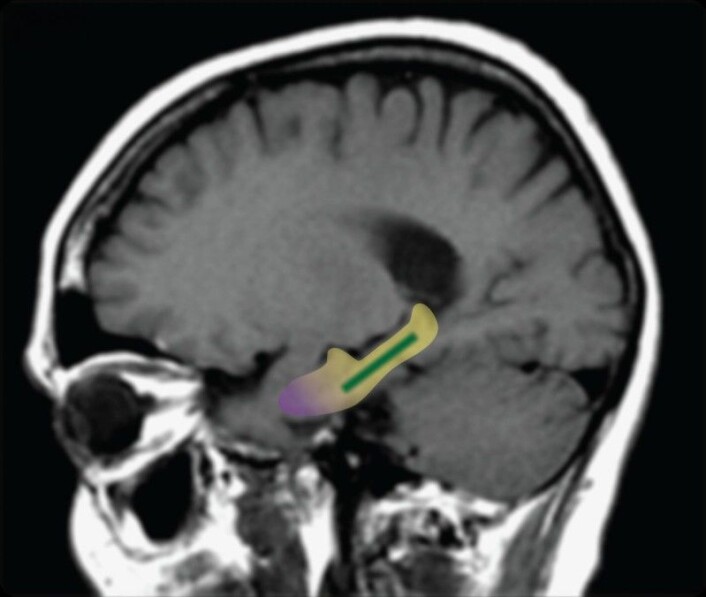 Det fargede området på bildet kalles dentate gyrus. Dette området blir mindre aktivt når vi blir eldre, og samtidig blir vi dårligere til å gjenkjenne objekter eller mønstre. (Foto: Scott A. Small) Det fargede området på bildet kalles dentate gyrus. Dette området blir mindre aktivt når vi blir eldre, og samtidig blir vi dårligere til å gjenkjenne objekter eller mønstre. (Foto: Scott A. Small)