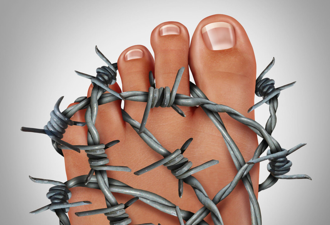 Symptoms of a gout attack are typically manifested in the big toe. It causes extremely painful joints. (Photo: Colourbox) Symptoms of a gout attack are typically manifested in the big toe. It causes extremely painful joints. (Photo: Colourbox)