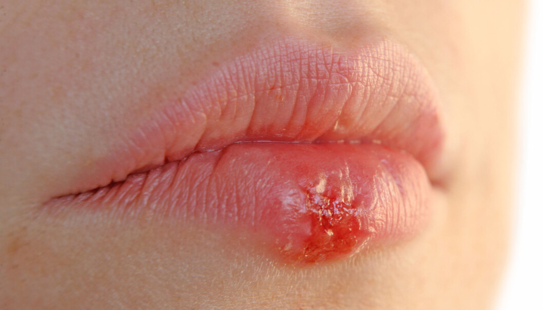 Herpesviruset er en vanlig infeksjon, men kan gi alvorlige konsekvenser med alderen. Illustrasjonsfoto: Colourbox Herpesviruset er en vanlig infeksjon, men kan gi alvorlige konsekvenser med alderen. Illustrasjonsfoto: Colourbox