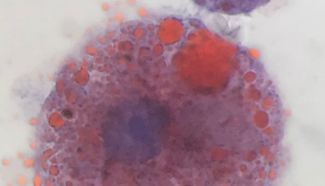 Immunceller med masse små fettperler er funnet i lungene til de lungesyke brukerne av E-sigaretter i USA. (Foto: Andrew Hansen/Jordan Valley Medical Center) Immunceller med masse små fettperler er funnet i lungene til de lungesyke brukerne av E-sigaretter i USA. (Foto: Andrew Hansen/Jordan Valley Medical Center)