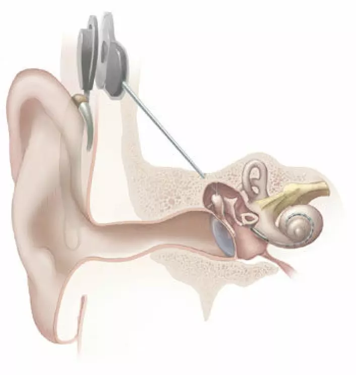 Cochlear-implantatet kobles direkte inn i øret, hvor det gir elektriske impulser. Det stimulerer hørselsnerven slik at hjernen oppfatter lyder.  (Foto: (Illustrasjonsbilde: National Institutes of Health/Wikimedia commons))