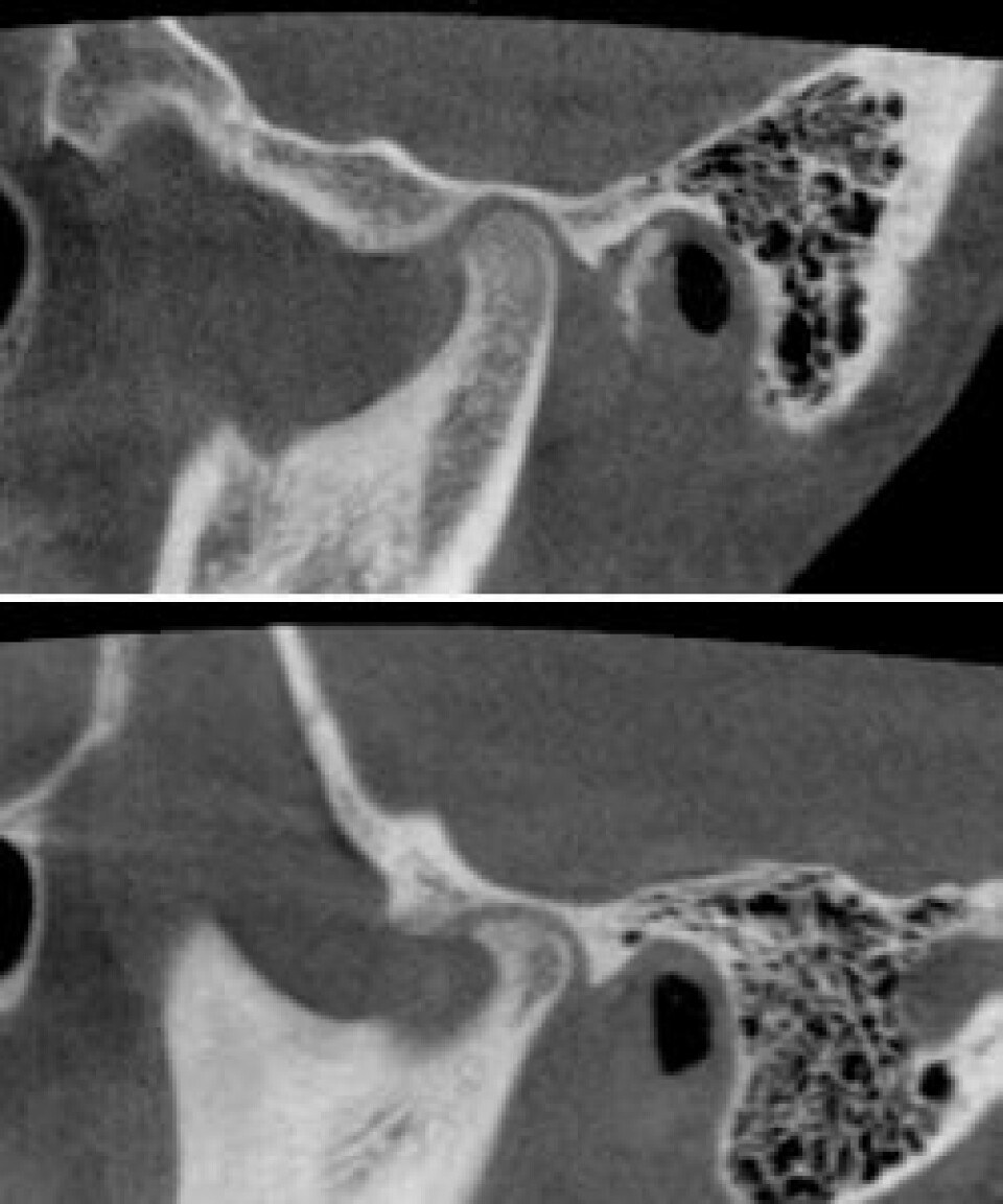 Øverst: Friskt kjeveledd på 14-årig jente. Nederst: 13-årig jente med kjeveleddsartrose. Her kan man se at sykdommen har forårsaket en formendring (nebbdannelse), slik at benet ikke lenger har en normal form. (Foto: Avdeling for kjeve- og ansiktsradiologi, UiO/OD)