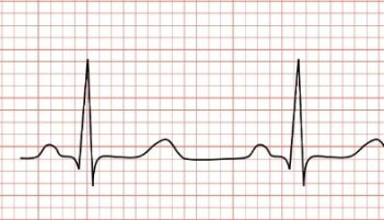 Elektrokardiografi (EKG) måler elektriske signaler fra hjertet. Elektrokardiografi (EKG) måler elektriske signaler fra hjertet.