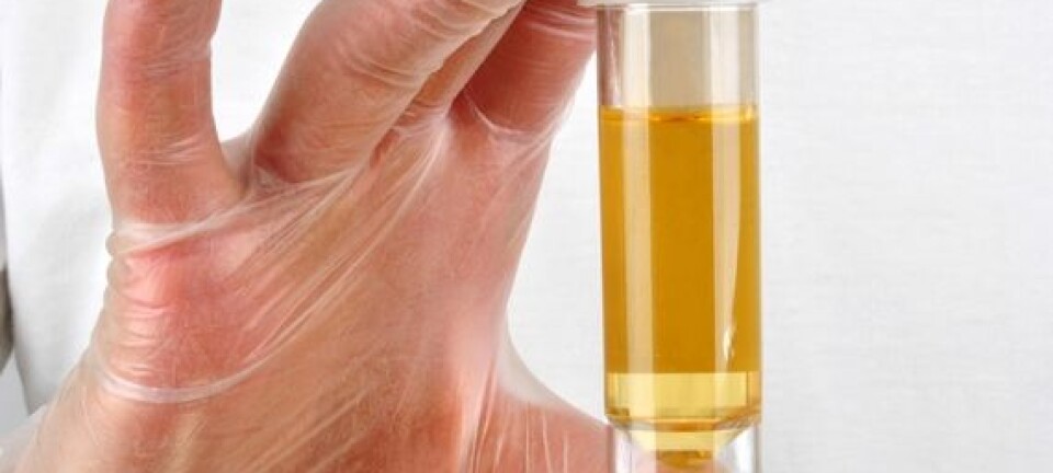 Synlig blod i urinen er vanligste tegn på blærekreft. En ny studie viser at også usynlig blod i urinen kan være et tegn på sykdommen.