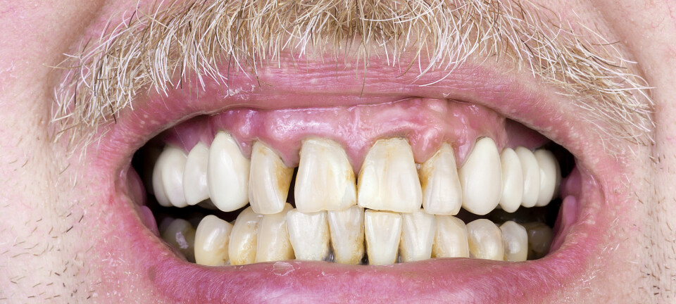 Eldres tenner får råtne på rot og kan få uopprettelige skader så lenge tannhelsetjeneste ikke er del av oppfølging ved alvorlig sykdom, viser ny forskning. (Foto: Microstock)