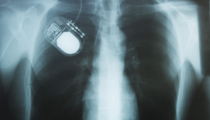 En liten maskin under huden på brystkassa fungerer som en pacemaker på hjernen. (Bilde: Image Point Fr / Shutterstock / NTB scanpix). En liten maskin under huden på brystkassa fungerer som en pacemaker på hjernen. (Bilde: Image Point Fr / Shutterstock / NTB scanpix).