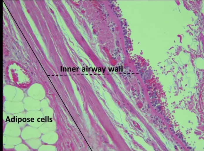 Dette bildet viser indre luftveier. Nederst til venstre kan du se fettceller (adipose cells). (Foto: European Respiratory Society) Dette bildet viser indre luftveier. Nederst til venstre kan du se fettceller (adipose cells). (Foto: European Respiratory Society)