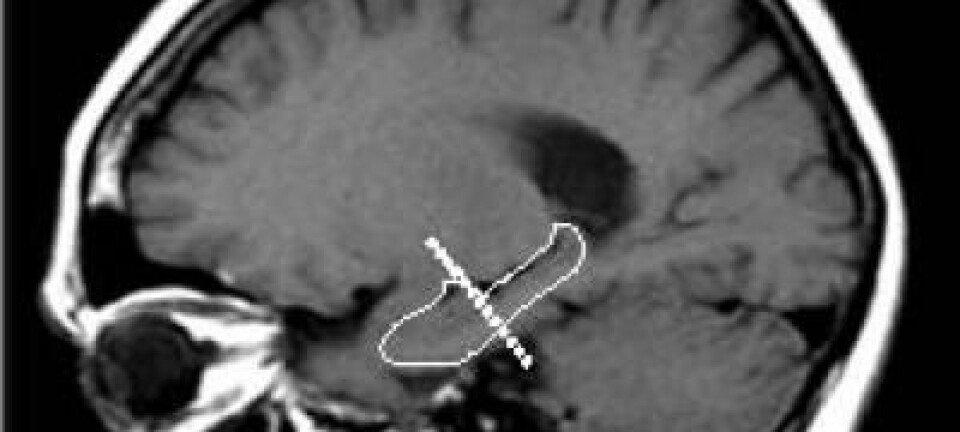 Plasseringen til hippocampus i hjernen. (Foto: Columbia University Medical Center)