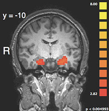 De røde flekkene i hjernen viser økt aktivitet i amygdala når en forsøksperson får en forbrytelse levende beskrevet. (Foto: Marois Lab) De røde flekkene i hjernen viser økt aktivitet i amygdala når en forsøksperson får en forbrytelse levende beskrevet. (Foto: Marois Lab)