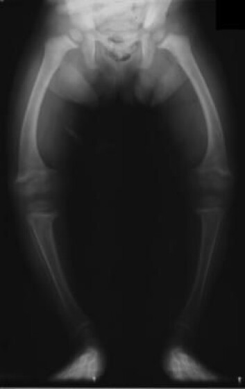 D-vitaminmangel kan føre til beinsykdommen rakitt, eller engelsk syke. Sykdommen fører blant annet til deformerte og skjøre knokler. (Illustrasjonsfoto: Michael L. Richardson/Creative Commons D-vitaminmangel kan føre til beinsykdommen rakitt, eller engelsk syke. Sykdommen fører blant annet til deformerte og skjøre knokler. (Illustrasjonsfoto: Michael L. Richardson/Creative Commons