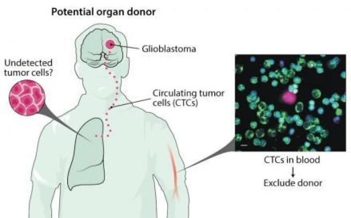 En kreftsvulst i hjernen kan sende ut kreftceller i organer som blir gitt videre til en donor. En internasjonal forskergruppe foreslår derfor at donorer blir testet for hjernekrefttypen GBM. (Illustrasjon: Science) En kreftsvulst i hjernen kan sende ut kreftceller i organer som blir gitt videre til en donor. En internasjonal forskergruppe foreslår derfor at donorer blir testet for hjernekrefttypen GBM. (Illustrasjon: Science)