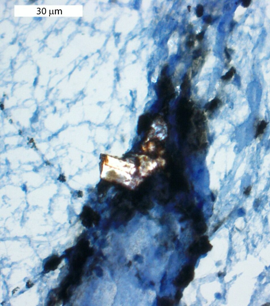The image shows a cholesterol crystal (bright white) surrounded by monocytes (brown staining) in material from a stroke patient. The scale bar is 30 µm (1000 µm = 1mm). (Photo: CEMIR)
