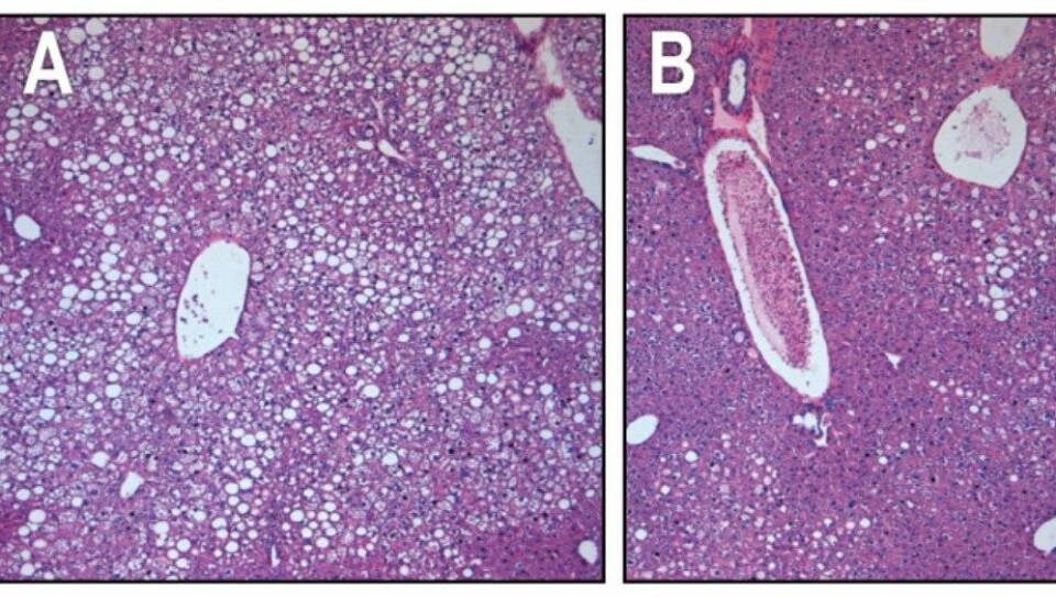 I levervevet hos mus med diabetes type 2 er fettfylte celler hvite (se bilde A.). Etter injeksjonen av FGF1-proteinet begynte cellene å kunne absorbere sukker fra blodet igjen (se bilde B). Dermed begynte de å ligne friske celler. (FOTO: SALK INSTITUTE FOR BIOLOGICAL STUDIES)