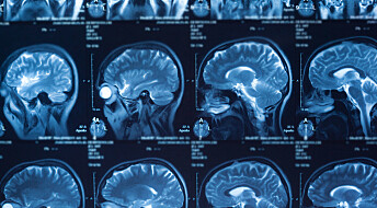 Test av smart medisin mot hjernekreft