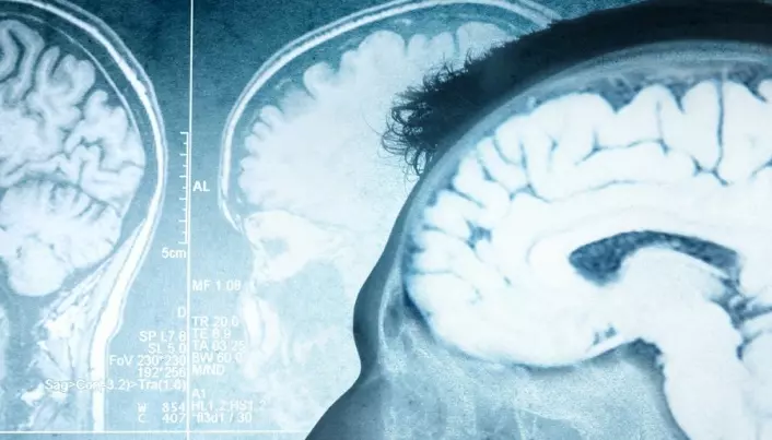 Kunstig intelligens gir mer kunnskap om hjernesykdommer