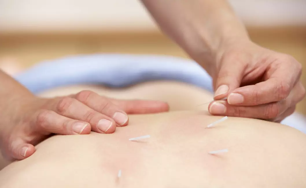 Kvinner med plager fra brystkreftbehandling fikk akupunktur - både ekte og simulert - i åtte uker. (Illustrasjonsfoto: Colourbox)