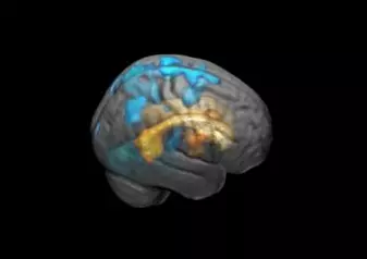 Påvirkningen fra de hvite flekkene sprer seg utover til hjernens overflate med økende volum. Her markert med blått.