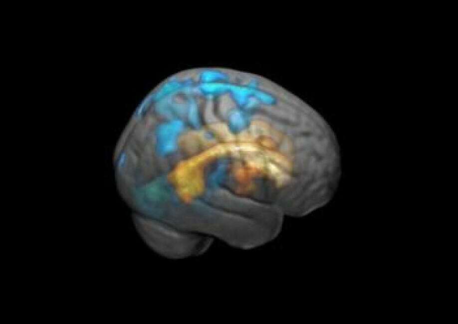 Påvirkningen fra de hvite flekkene sprer seg utover til hjernens overflate med økende volum. Her markert med blått.