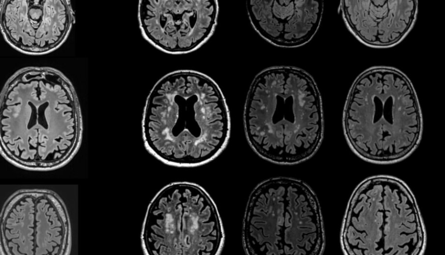 Bildet viser ulike MR av ulike hjerner med ulik grad av hvite flekker.