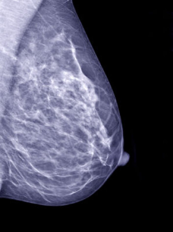 Mammogram. (Foto: iStockphoto) Mammogram. (Foto: iStockphoto)