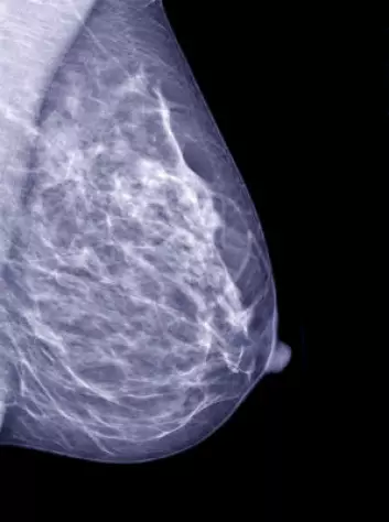 Mammogram. (Foto: iStockphoto)