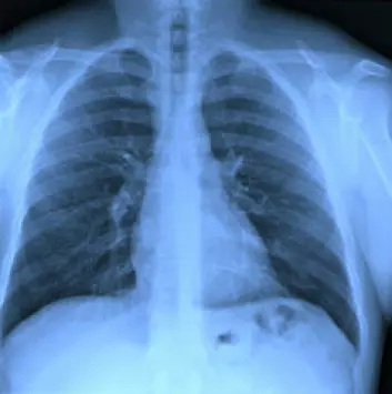 Tuberkulose er på frammarsj igjen. Sykdommen synes på røntgenbilder. (Foto: Shutterstock)