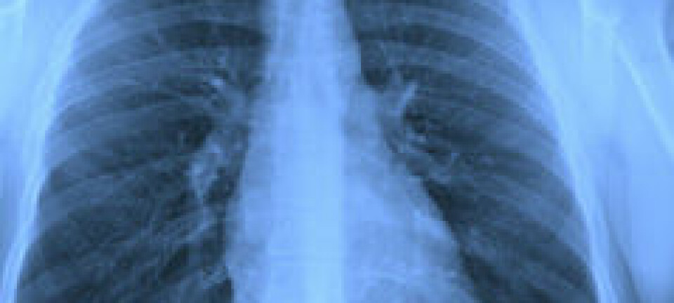 Tuberkulose er på frammarsj igjen. Sykdommen synes på røntgenbilder. Shutterstock