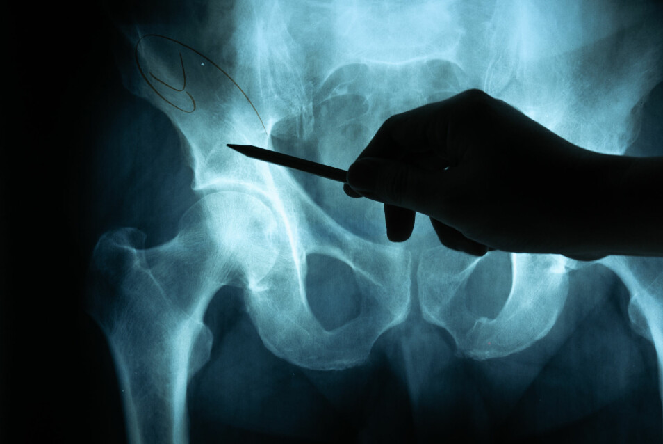 Rundt 21 prosent av kvinner med hoftebrudd dør i løpet av det første året etter skaden, og hele 33 prosent av mennene.