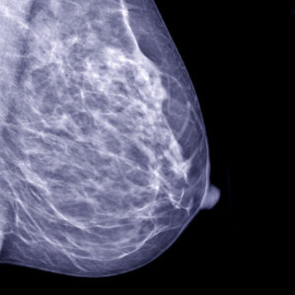 Mammogram. (Foto: Istockphoto)