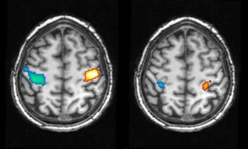 Bildene viser aktivitet i den motoriske hjernebarken ved knytting av neve i våken tilstand (venstre) og ved en drømt neveknytting (høyre). Blå områder indikerer aktiviteten ved knytting av høyre hånd, mens oransje regioner indikerer knytting av venstre hånd. (Foto: MIP of Psychiatry)